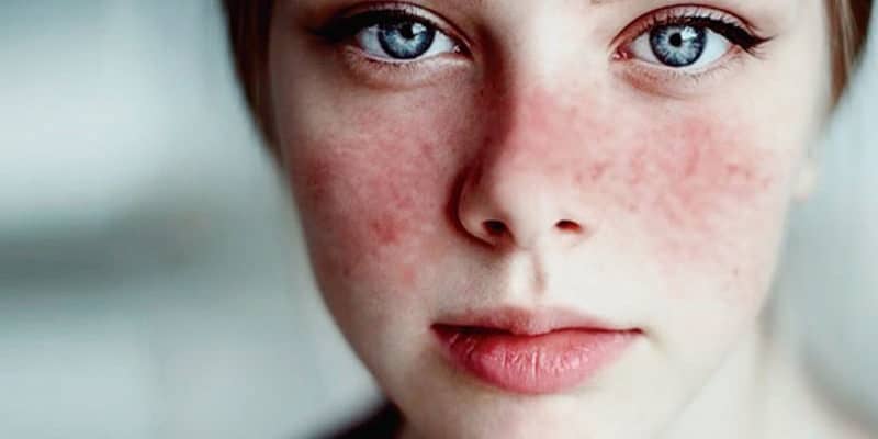 Penyebab Penyakit Lupus